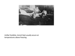 Unlike frostbite, trench foot usually occurs at
temperatures above freezing.
 