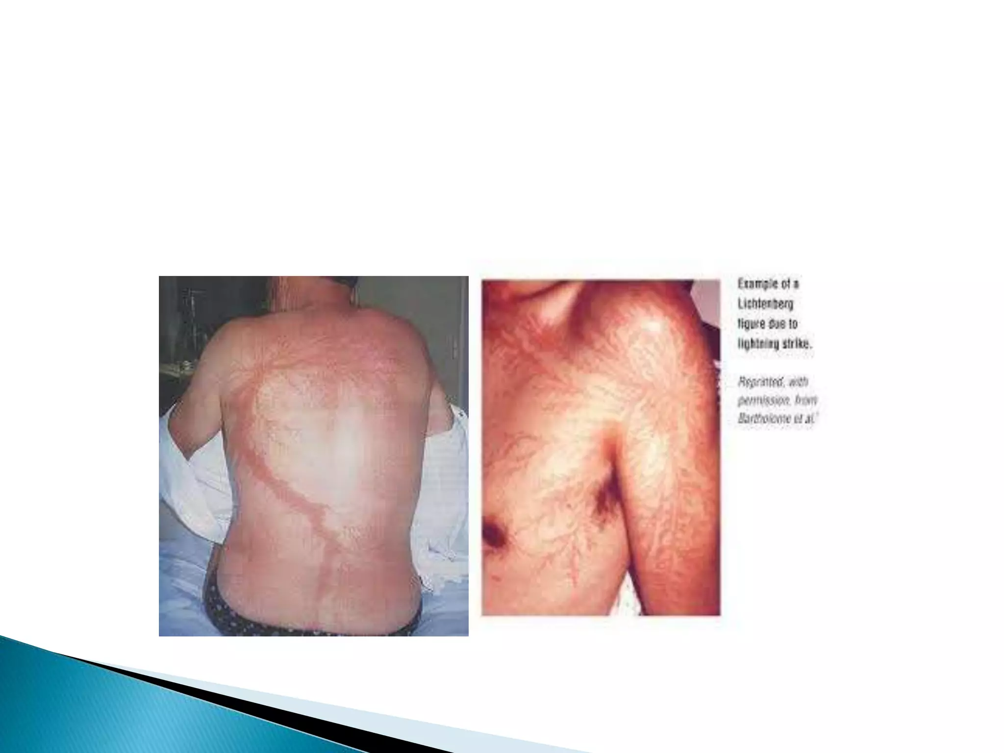 Thermal injury | PPTX