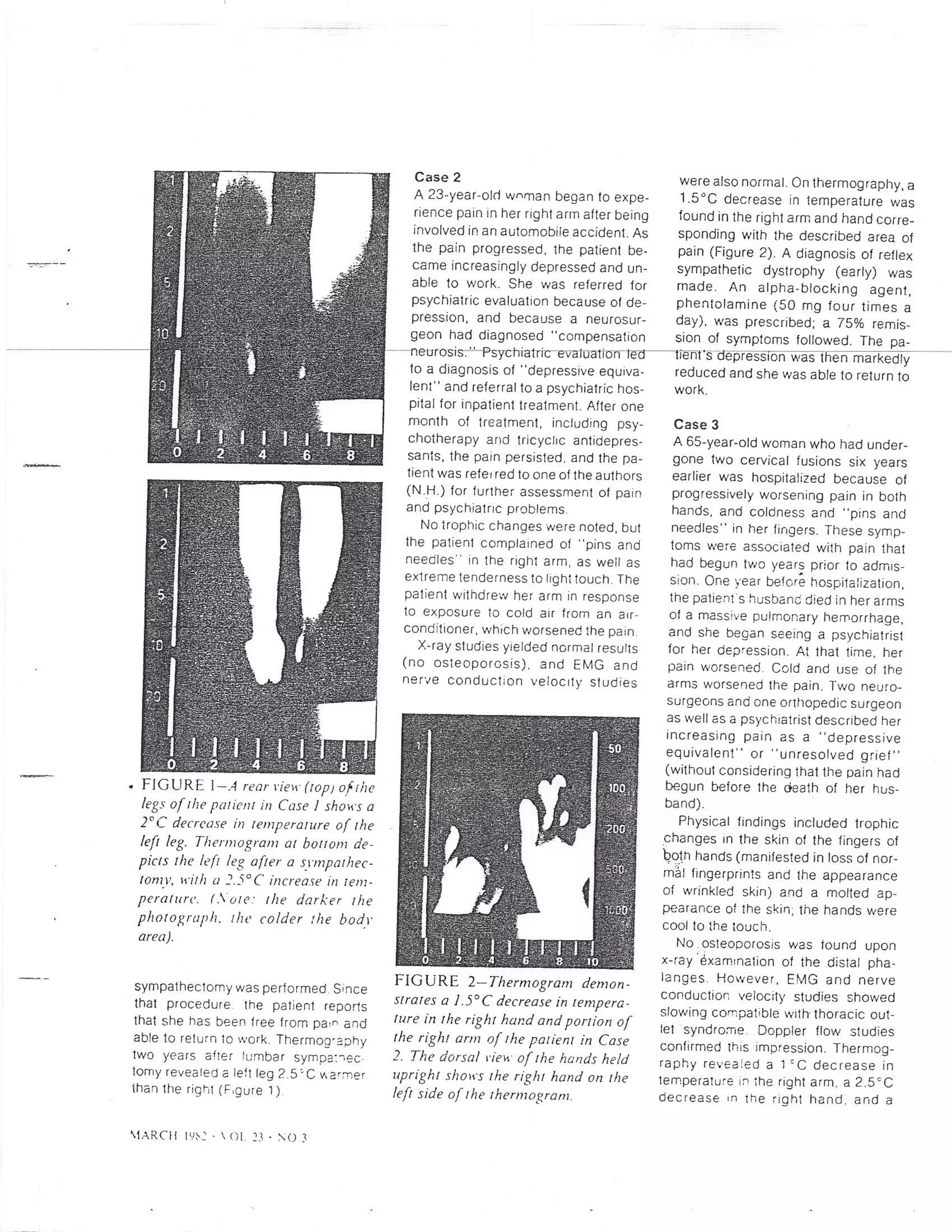 Thermography for psychogenic pain