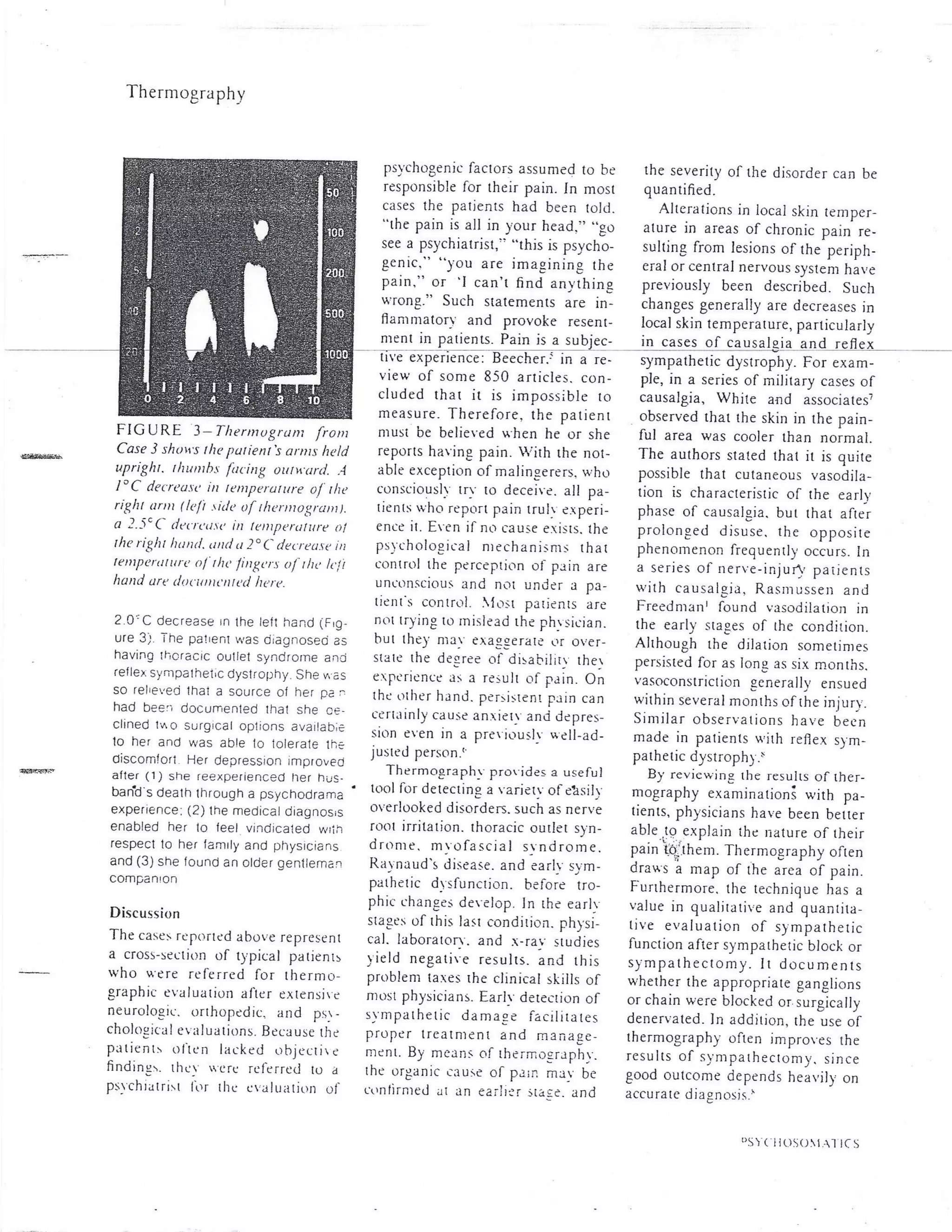 Thermography for psychogenic pain