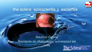 the sclera: epiescleritis y escleritis
Mauricio Giraldo
Residente de oftalmología universidad del
valle
 