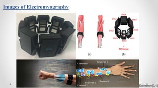 Images of Electromyography
 Reference[3,4]
 