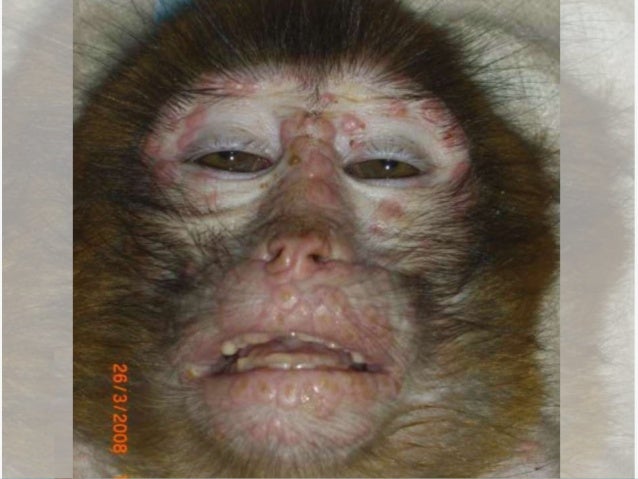 monkeypox update
