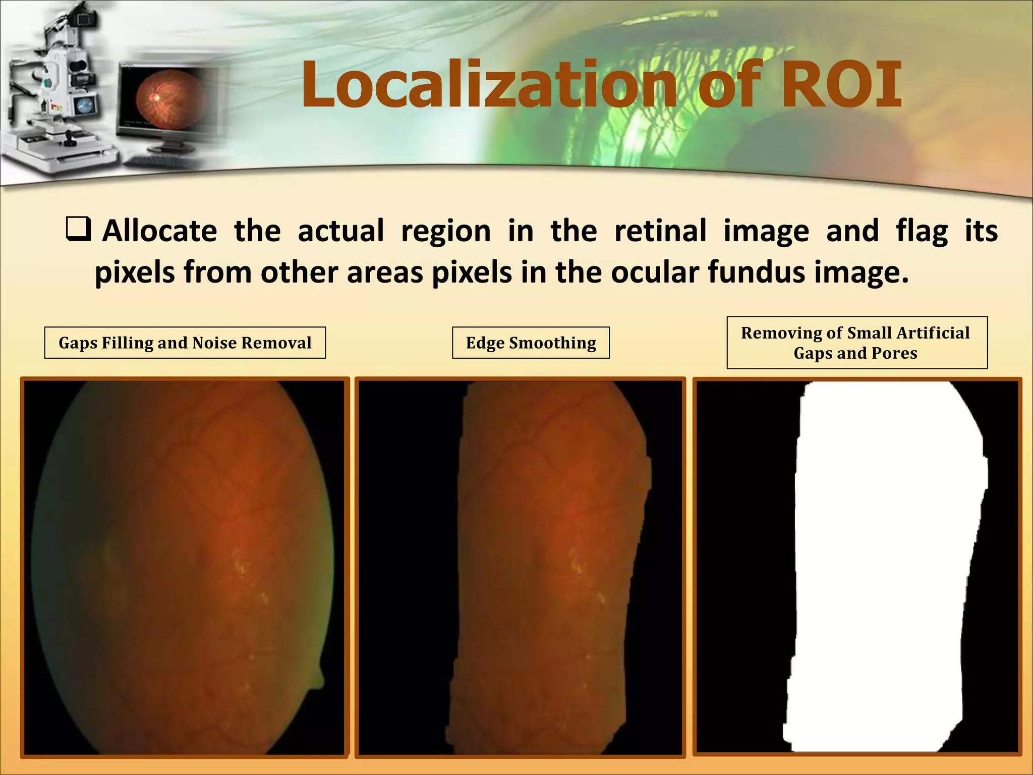 Localization of ROI 
 Allocate the actual region in the retinal image and flag its 
pixels from other areas pixels in the ocular fundus image. 
퐆퐚퐩퐬 퐅퐢퐥퐥퐢퐧퐠 퐚퐧퐝 퐍퐨퐢퐬퐞 퐑퐞퐦퐨퐯퐚퐥 퐄퐝퐠퐞 퐒퐦퐨퐨퐭퐡퐢퐧퐠 
퐑퐞퐦퐨퐯퐢퐧퐠 퐨퐟 퐒퐦퐚퐥퐥 퐀퐫퐭퐢퐟퐢퐜퐢퐚퐥 
퐆퐚퐩퐬 퐚퐧퐝 퐏퐨퐫퐞퐬 
 