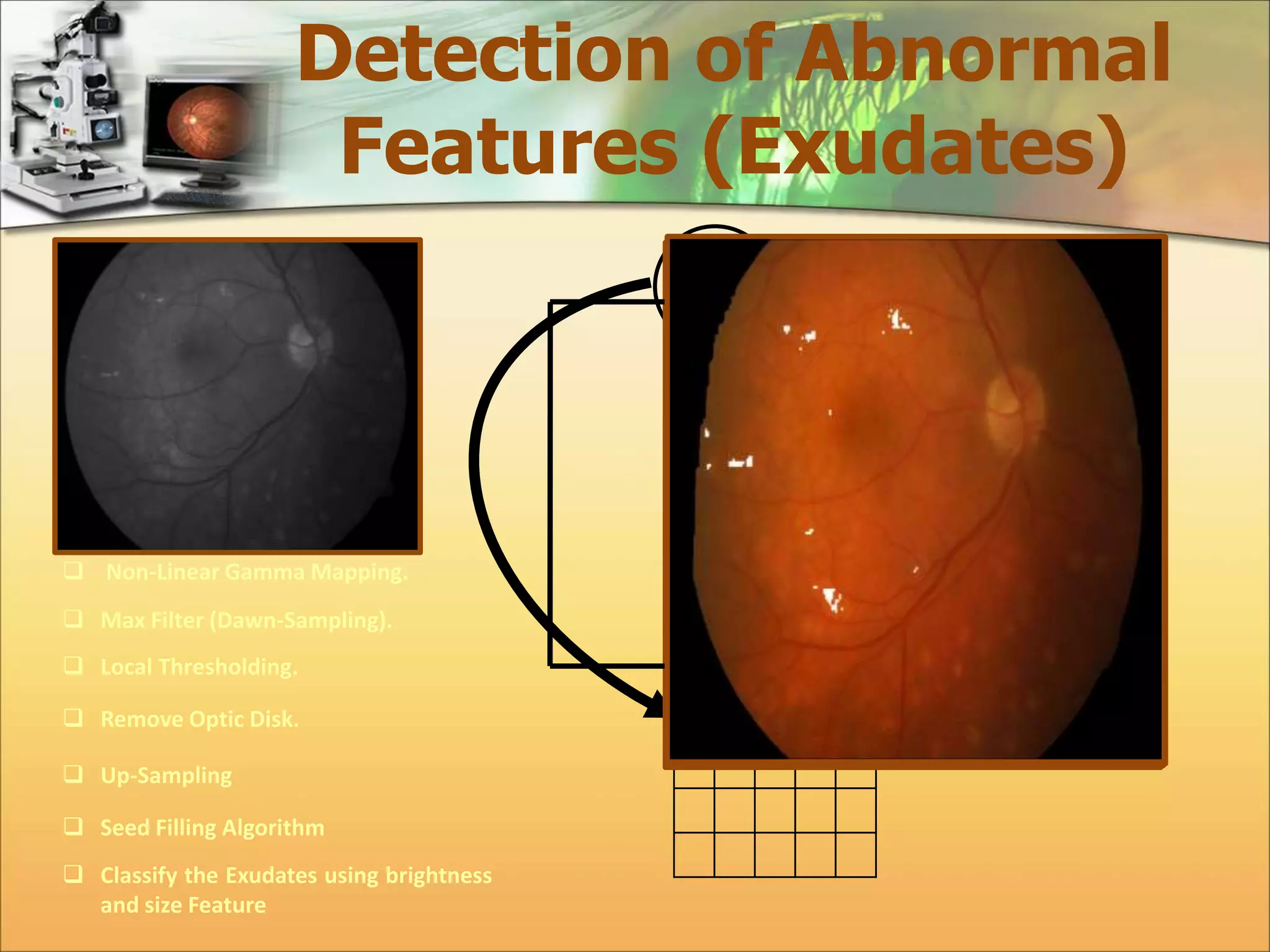 Detection of Abnormal 
Features (Exudates) 
 Non-Linear Gamma Mapping. 
 Max Filter (Dawn-Sampling). 
 Local Thresholding. 
 Remove Optic Disk. 
 Up-Sampling 
 Seed Filling Algorithm 
 Classify the Exudates using brightness 
and size Feature 
3 5 
2 6 
6 
x,y x+1,y x+2,y 
x,y+1 x+1,y+1 x+2,y+1 
x,y+2 x+1,y+2 x+2,y+2 
2x,2y 2x+1,y 
2x,2y+1 2x+1,2y+1 
 