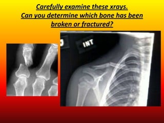 Carefully examine these xrays.
Can you determine which bone has been
         broken or fractured?
 