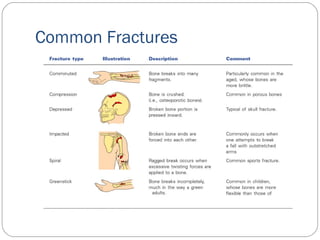 Common Fractures
 