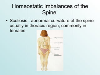 Homeostatic Imbalances of the Spine  Scoliosis:  abnormal curvature of the spine usually in thoracic region, commonly in females 
