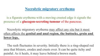 Necrolytic migratory erythema
is a figurate erythema with a moving crusted edge it signals the
presence of a glucagon-secreting tumour of the pancreas.
Necrolytic migratory erythema may affect any site but it most
often affects the genital and anal region, the buttocks, groin and
lower legs.
The rash fluctuates in severity. Initially there is a ring-shaped red
area that blisters, erodes and crusts over. It can be quite itchy and
painful. As it heals, it may leave behind a brown mark.
 
