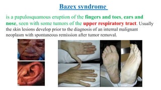 is a papulosquamous eruption of the fingers and toes, ears and
nose, seen with some tumors of the upper respiratory tract. Usually
the skin lesions develop prior to the diagnosis of an internal malignant
neoplasm with spontaneous remission after tumor removal.
Bazex syndrome
 