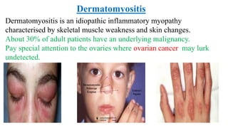 Dermatomyositis is an idiopathic inflammatory myopathy
characterised by skeletal muscle weakness and skin changes.
About 30% of adult patients have an underlying malignancy.
Pay special attention to the ovaries where ovarian cancer may lurk
undetected.
Dermatomyositis
 