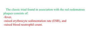 The classic triad found in association with the red oedematous
plaques consists of:
-fever,
-raised erythrocyte sedimentation rate (ESR), and
-raised blood neutrophil count.
 