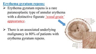 Erythema gyratum repens:
 Erythema gyratum repens is a rare
paraneoplastic type of annular erythema
with a distinctive figurate ‘wood-grain’
appearance.
 There is an associated underlying
malignancy in 80% of patients with
erythema gyratum repens.
 