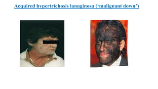 Acquired hypertrichosis lanuginosa (‘malignant down’)
 