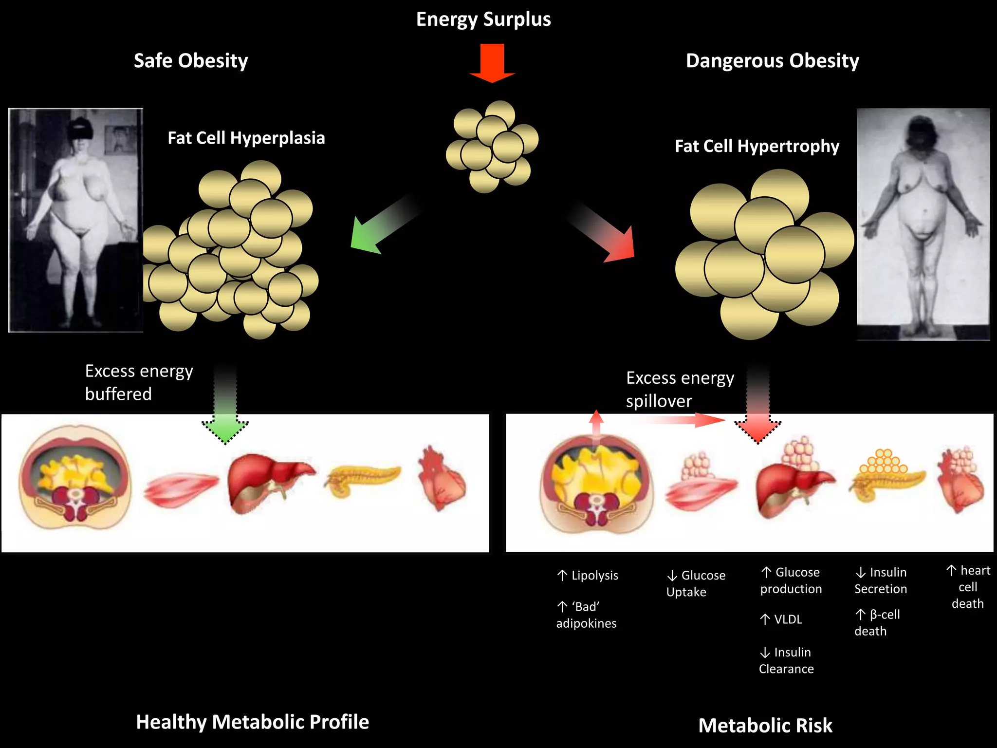 Energy SurplusFat Cell HyperplasiaFat Cell HypertrophySafe ObesityDangerous ObesityExcess energy bufferedExcess energy spillover↑ heart      cell death↑ Glucose production↓ Insulin Secretion↑ Lipolysis↓ Glucose Uptake↑ ‘Bad’ adipokines↑ β-cell death↑ VLDL↓ Insulin ClearanceHealthy Metabolic ProfileMetabolic Risk