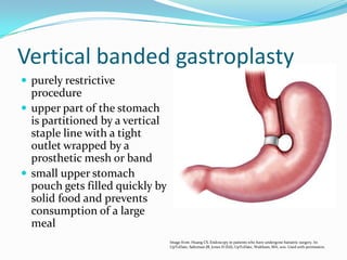 Vertical Banded Gastroplasty