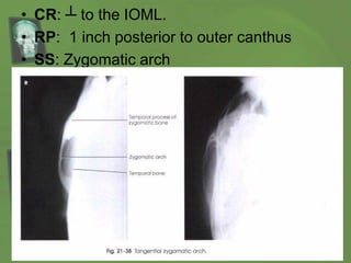 • CR: ┴ to the IOML.
• RP: 1 inch posterior to outer canthus
• SS: Zygomatic arch
 