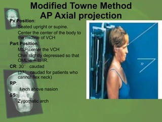 Modified Towne Method
AP Axial projectionPx Position:
Seated upright or supine.
Center the center of the body to
the midline of VCH
Part Position:
MSP center the VCH
Chin slightly depressed so that
OML is ┴ to IR.
CR: 30° caudad
(37° caudad for patients who
cannot flex neck)
RP:
1inch above nasion
SS:
Zygomatic arch
 