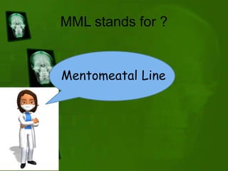 MML stands for ?
Mentomeatal Line
 
