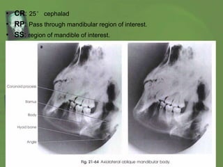 • CR: 25° cephalad
• RP: Pass through mandibular region of interest.
• SS: region of mandible of interest.
 