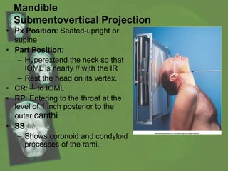Mandible
Submentovertical Projection
• Px Position: Seated-upright or
supine
• Part Position:
– Hyperextend the neck so that
IOML is nearly // with the IR
– Rest the head on its vertex.
• CR: ┴ to IOML
• RP: Entering to the throat at the
level of 1 inch posterior to the
outer canthi
• SS:
– Shows coronoid and condyloid
processes of the rami.
 