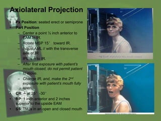 Axiolateral Projection
• Px Position: seated erect or semiprone
• Part Position
– Center a point ½ inch anterior to
EAM to IR.
– Rotate MSP 15° toward IR.
– Adjust AML // with the transverse
axis of IR
– IPL is ┴ to IR.
– After first exposure with patient’s
mouth closed, do not permit patient
to move.
– Change IR, and, make the 2nd
exposure with patient’s mouth fully
open.
• CR: ┴ at 25°-30°
• RP: 1 inch anterior and 2 inches
superior to the upside EAM
• SS: TMJs in an open and closed mouth
 