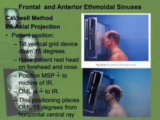 Frontal and Anterior Ethmoidal Sinuses
Caldwell Method
PA Axial Projection
• Patient position:
– Tilt vertical grid device
down 15 degrees.
– Have patient rest head
on forehead and nose.
– Position MSP ┴ to
midline of IR.
– OML is ┴ to IR.
– This positioning places
OML 15 degrees from
horizontal central ray
 