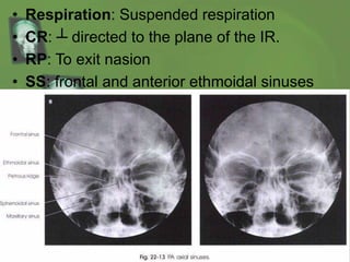 • Respiration: Suspended respiration
• CR: ┴ directed to the plane of the IR.
• RP: To exit nasion
• SS: frontal and anterior ethmoidal sinuses
 