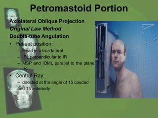 Petromastoid Portion
Axiolateral Oblique Projection
Original Law Method
Double-tube Angulation
• Patient position:
– Head in a true lateral
– IPL perpendicular to IR
– MSP and IOML parallel to the plane of
IR.
• Central Ray:
– directed at the angle of 15 caudad
and 15 anteriorly
 