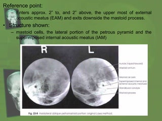 Reference point:
– Enters approx. 2” to, and 2” above, the upper most of external
acoustic meatus (EAM) and exits downside the mastoid process.
• Structure shown:
– mastoid cells, the lateral portion of the petrous pyramid and the
superimposed internal acoustic meatus (IAM)
 