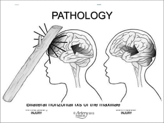 PATHOLOGY
1. ) Basal Fx
Fx located at the base of the skull
2) Blowout Fx
Fx of the floor of the orbit
3.) Contre-Coup Fx
Fx to one side of a structure caused by
trauma to the other side
4.) Depressed Fx
Fx causing a portion of the skull to be depressed
into the cranial cavity
5.) Le Fort Fx
Bilateral horizontal fxs of the maxillae
 