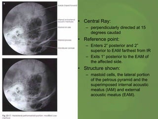 • Central Ray:
– perpendicularly directed at 15
degrees caudad
• Reference point:
– Enters 2” posterior and 2”
superior to EAM farthest from IR
– Exits 1” posterior to the EAM of
the affected side.
• Structure shown:
– mastoid cells, the lateral portion
of the petrous pyramid and the
superimposed internal acoustic
meatus (IAM) and external
acoustic meatus (EAM).
 