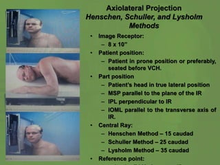 Axiolateral Projection
Henschen, Schuller, and Lysholm
Methods
• Image Receptor:
– 8 x 10’’
• Patient position:
– Patient in prone position or preferably,
seated before VCH.
• Part position
– Patient’s head in true lateral position
– MSP parallel to the plane of the IR
– IPL perpendicular to IR
– IOML parallel to the transverse axis of
IR.
• Central Ray:
– Henschen Method – 15 caudad
– Schuller Method – 25 caudad
– Lysholm Method – 35 caudad
• Reference point:
 