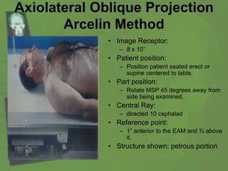Axiolateral Oblique Projection
Arcelin Method
• Image Receptor:
– 8 x 10’’
• Patient position:
– Position patient seated erect or
supine centered to table.
• Part position:
– Rotate MSP 45 degrees away from
side being examined.
• Central Ray:
– directed 10 cephalad
• Reference point:
– 1” anterior to the EAM and ¾ above
it.
• Structure shown: petrous portion
 