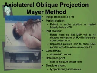 Axiolateral Oblique Projection
Mayer Method
• Image Receptor: 8 x 10’’
• Patient position:
– Patient in supine position or seated
laterally before VCH.
• Part position:
– Rotate head so that MSP will be 45
degrees to the plane of IR, with side under
study closest to IR.
– Depressed patient’s chin to place IOML
parallel to the transverse axis of the IR.
• Central Ray:
– directed 45 caudad
• Reference point:
– exits to the EAM closest to IR
• Structure shown:
– tympanic cavity and ossicles
 