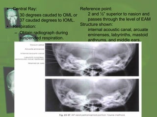 • Central Ray:
– 30 degrees caudad to OML or
37 caudad degrees to IOML.
• Respiration:
– Obtain radiograph during
suspended respiration.
Reference point:
2 and ½” superior to nasion and
passes through the level of EAM
Structure shown:
internal acoustic canal, arcuate
eminenses, labyrinths, mastoid
anthrums, and middle ears.
 