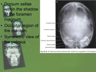 • Dorsum sellae
within the shadow
of the foramen
magnum
• Occipital region of
the cranium
• Symmetric view of
the petrous
pyramid
 