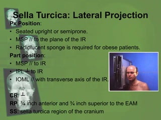 Sella Turcica: Lateral Projection
Px Position:
• Seated upright or semiprone.
• MSP // to the plane of the IR
• Radiolucent sponge is required for obese patients.
Part position:
• MSP // to IR
• IPL ┴ to IR
• IOML // with transverse axis of the IR.
CR: ┴
RP: ¾ inch anterior and ¾ inch superior to the EAM
SS: sella turcica region of the cranium
 