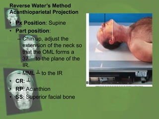Reverse Water’s Method
Acanthioparietal Projection
• Px Position: Supine
• Part position:
– Chin up, adjust the
extension of the neck so
that the OML forms a
37° to the plane of the
IR.
– MML ┴ to the IR
• CR: ┴
• RP: Acanthion
• SS: Superior facial bone
 