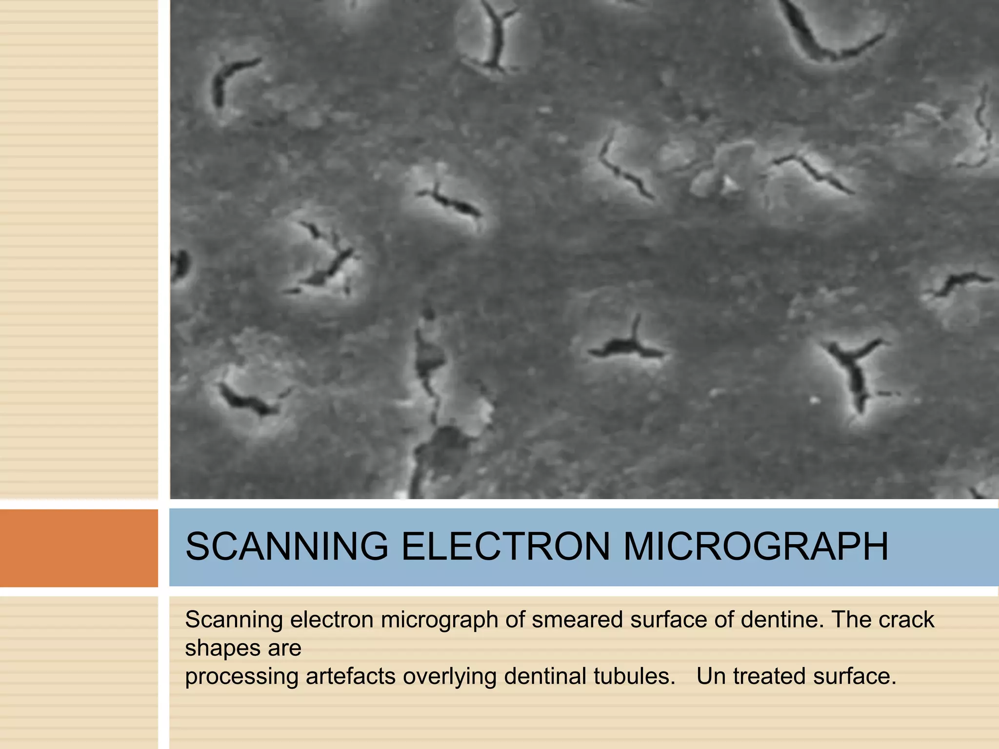 Scanning electron micrograph of smeared surface of dentine. The crack
shapes are
processing artefacts overlying dentinal tubules. Un treated surface.
SCANNING ELECTRON MICROGRAPH
 