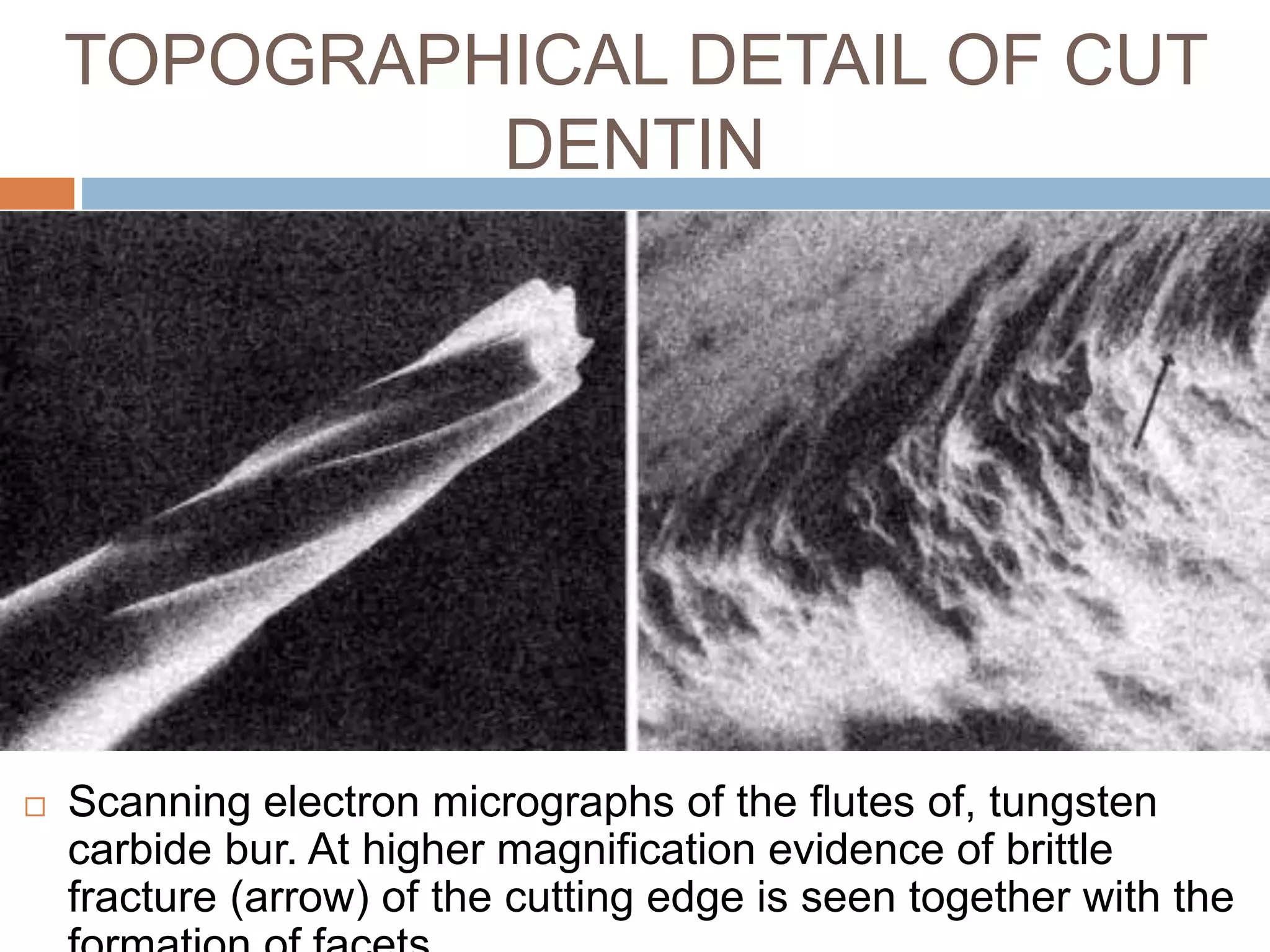  Scanning electron micrographs of the flutes of, tungsten
carbide bur. At higher magnification evidence of brittle
fracture (arrow) of the cutting edge is seen together with the
TOPOGRAPHICAL DETAIL OF CUT
DENTIN
 
