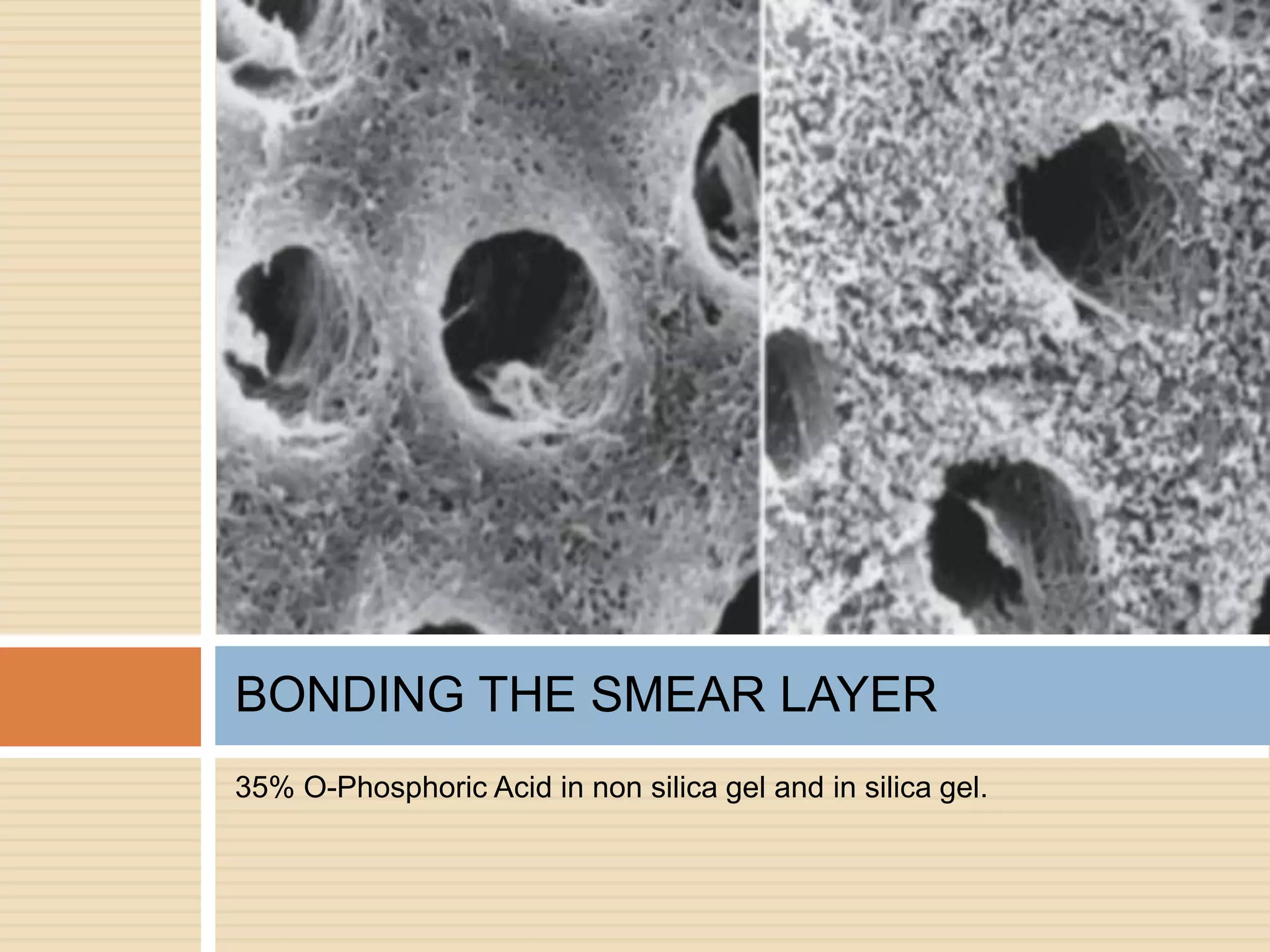 35% O-Phosphoric Acid in non silica gel and in silica gel.
BONDING THE SMEAR LAYER
 
