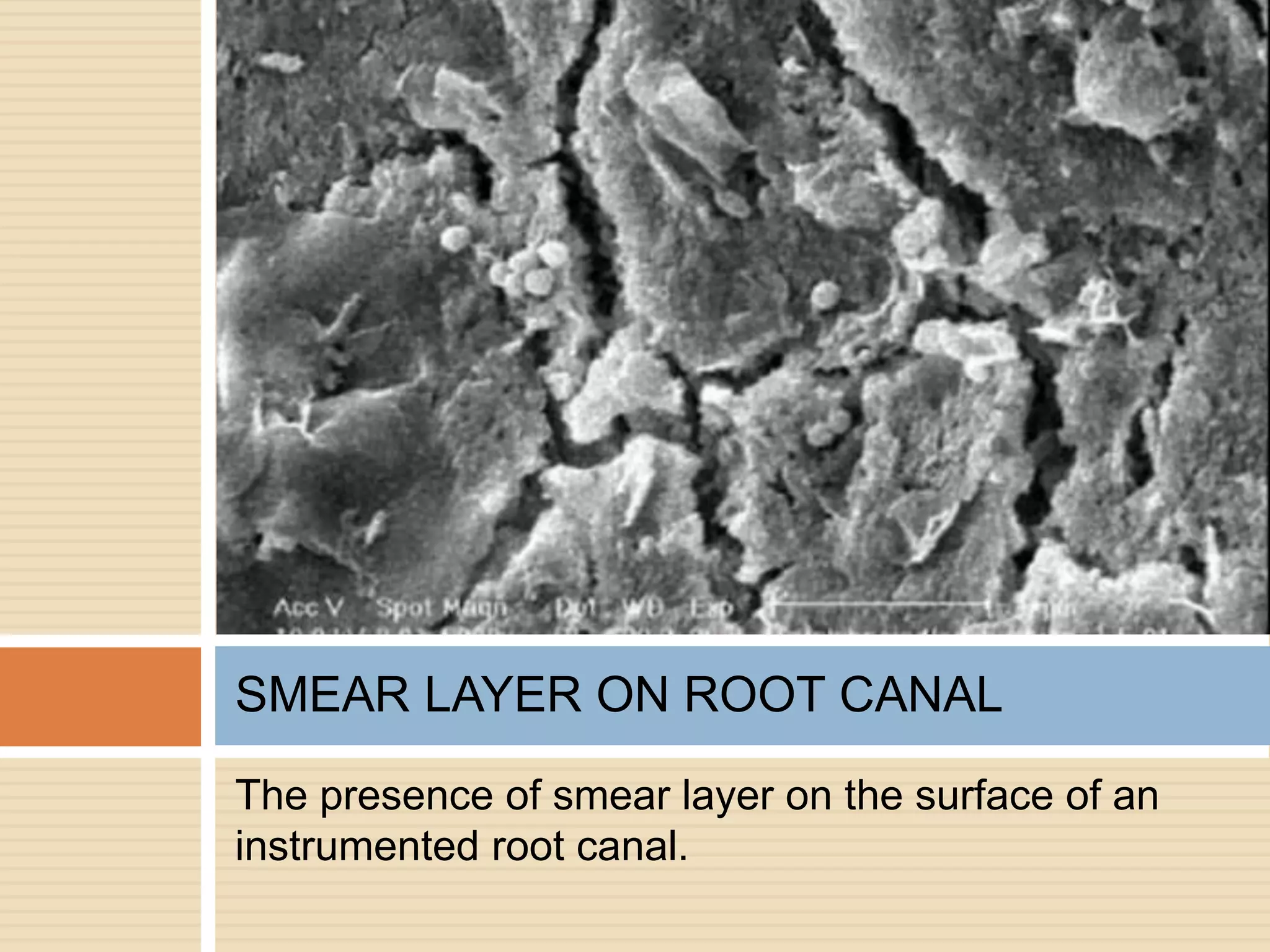 The presence of smear layer on the surface of an
instrumented root canal.
SMEAR LAYER ON ROOT CANAL
 