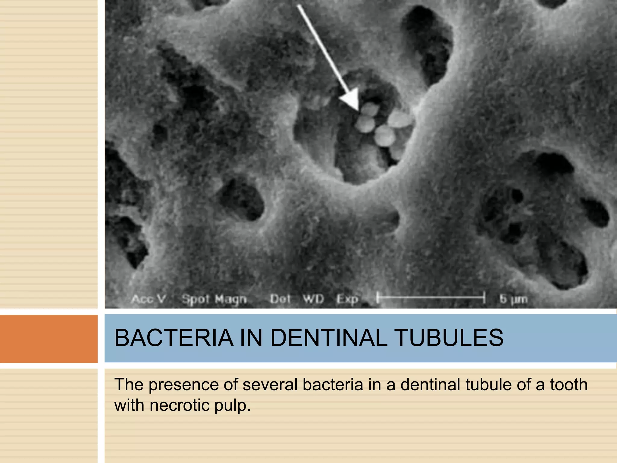 The presence of several bacteria in a dentinal tubule of a tooth
with necrotic pulp.
BACTERIA IN DENTINAL TUBULES
 
