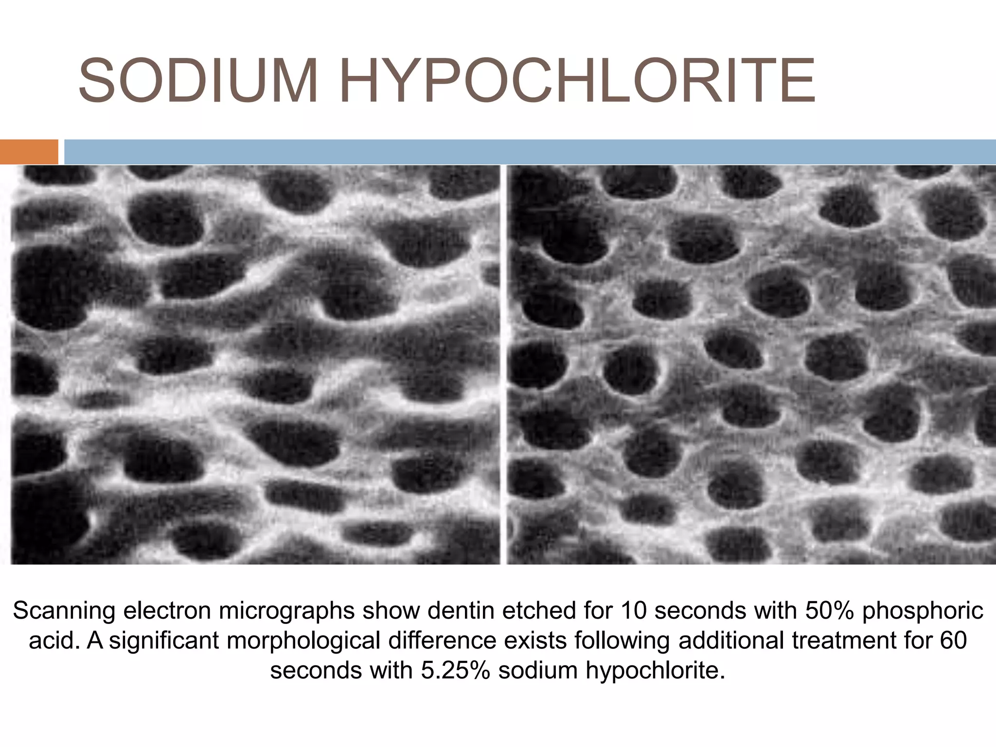 SODIUM HYPOCHLORITE
Scanning electron micrographs show dentin etched for 10 seconds with 50% phosphoric
acid. A significant morphological difference exists following additional treatment for 60
seconds with 5.25% sodium hypochlorite.
 