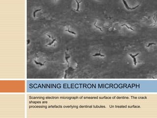 Scanning electron micrograph of smeared surface of dentine. The crack
shapes are
processing artefacts overlying dentinal tubules. Un treated surface.
SCANNING ELECTRON MICROGRAPH
 