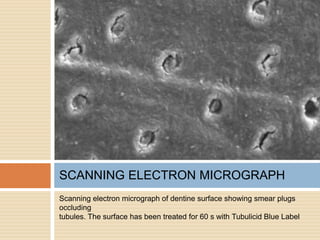 Scanning electron micrograph of dentine surface showing smear plugs
occluding
tubules. The surface has been treated for 60 s with Tubulicid Blue Label
SCANNING ELECTRON MICROGRAPH
 