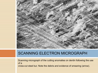 Scanning micrograph of the cutting anomalies on dentin following the use
of a
cross-cut steel bur. Note the debris and evidence of smearing (arrow).
SCANNING ELECTRON MICROGRAPH
 