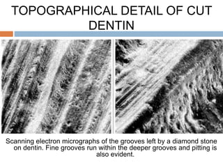 TOPOGRAPHICAL DETAIL OF CUT
DENTIN
Scanning electron micrographs of the grooves left by a diamond stone
on dentin. Fine grooves run within the deeper grooves and pitting is
also evident.
 