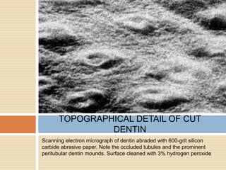 Scanning electron micrograph of dentin abraded with 600-grit silicon
carbide abrasive paper. Note the occluded tubules and the prominent
peritubular dentin mounds. Surface cleaned with 3% hydrogen peroxide
TOPOGRAPHICAL DETAIL OF CUT
DENTIN
 